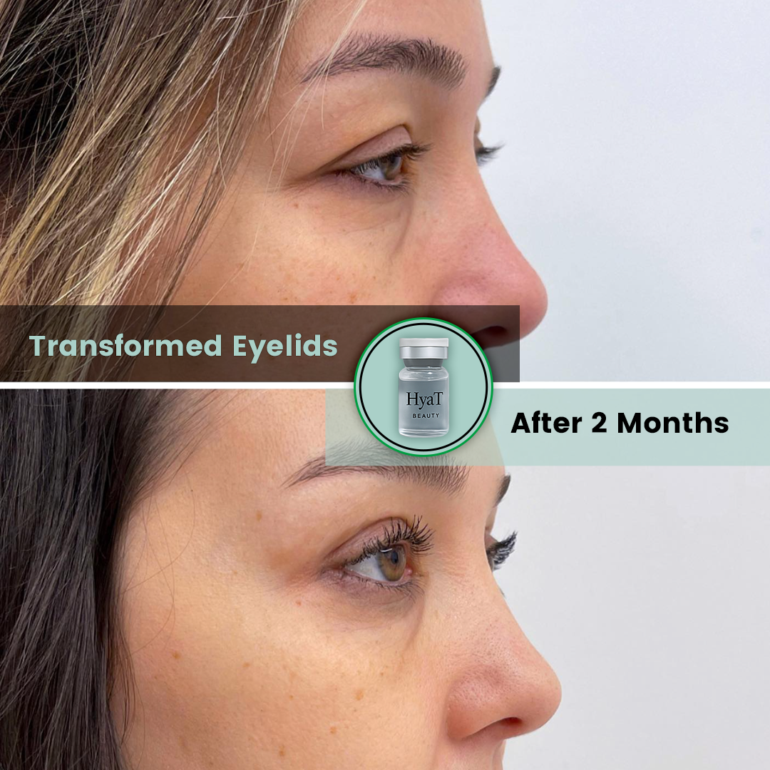 HyaT™ Upper Eyelid Matrixyl® 3000 & Adenosine Micro-Infusion System