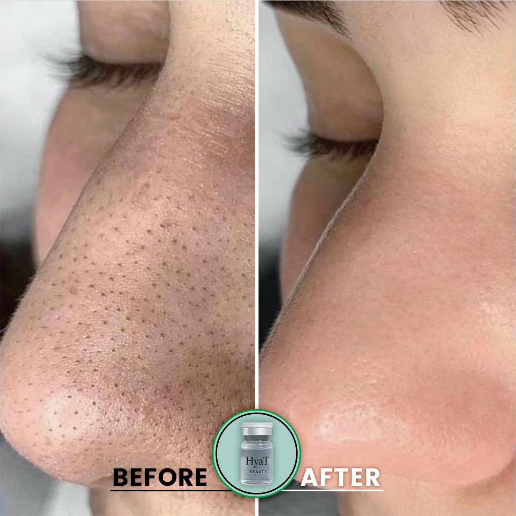 HyaT™ Pore Micro-Infusion System
