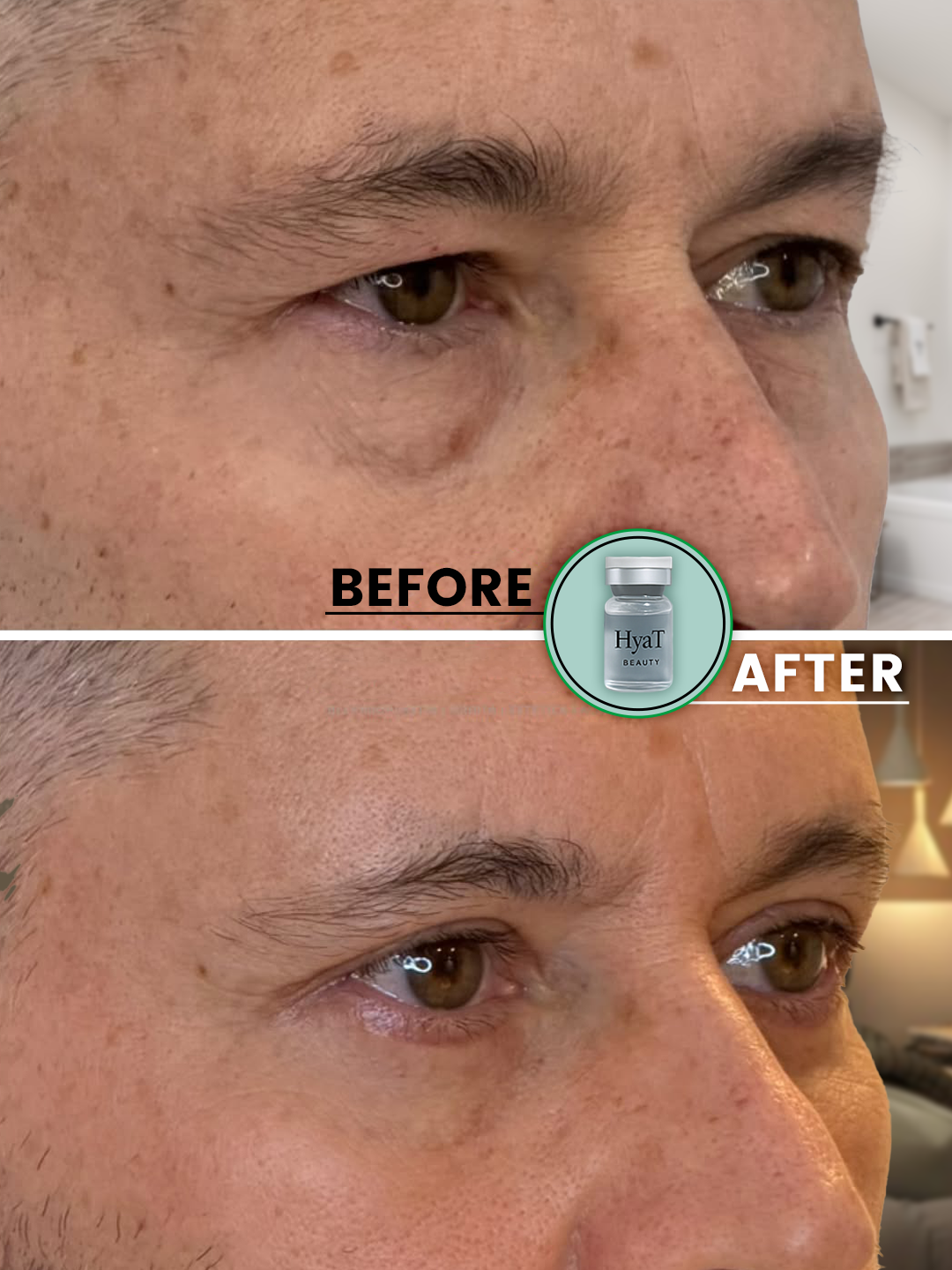 HyaT™ Upper Eyelid Matrixyl® 3000 & Adenosine Micro-Infusion System