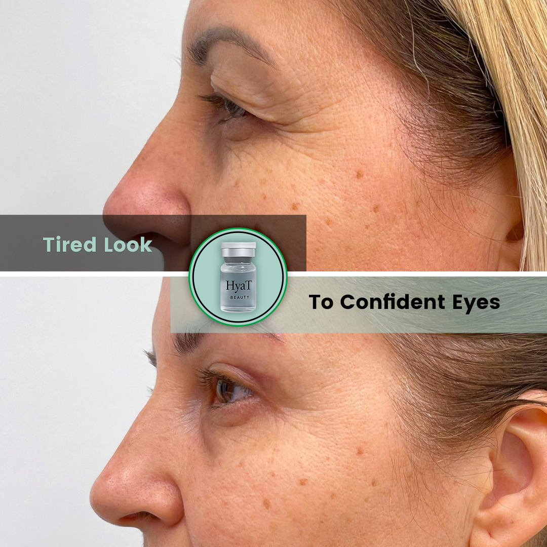 HyaT™ Upper Eyelid Matrixyl® 3000 & Adenosine Micro-Infusion System