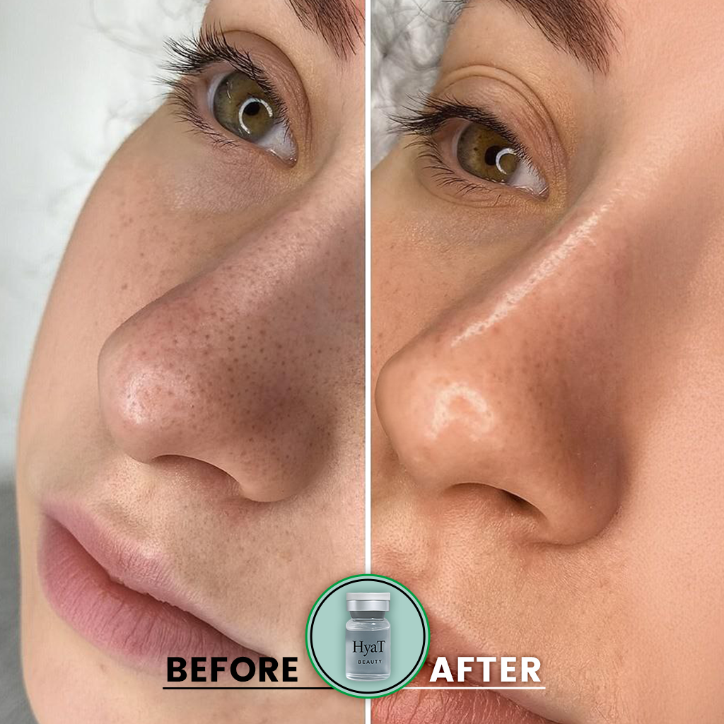 HyaT™ Pore Micro-Infusion System