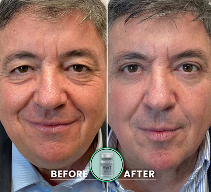 HyaT™ Upper Eyelid Matrixyl® 3000 & Adenosine Micro-Infusion System