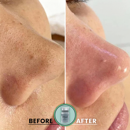 HyaT™ Pore Micro-Infusion System