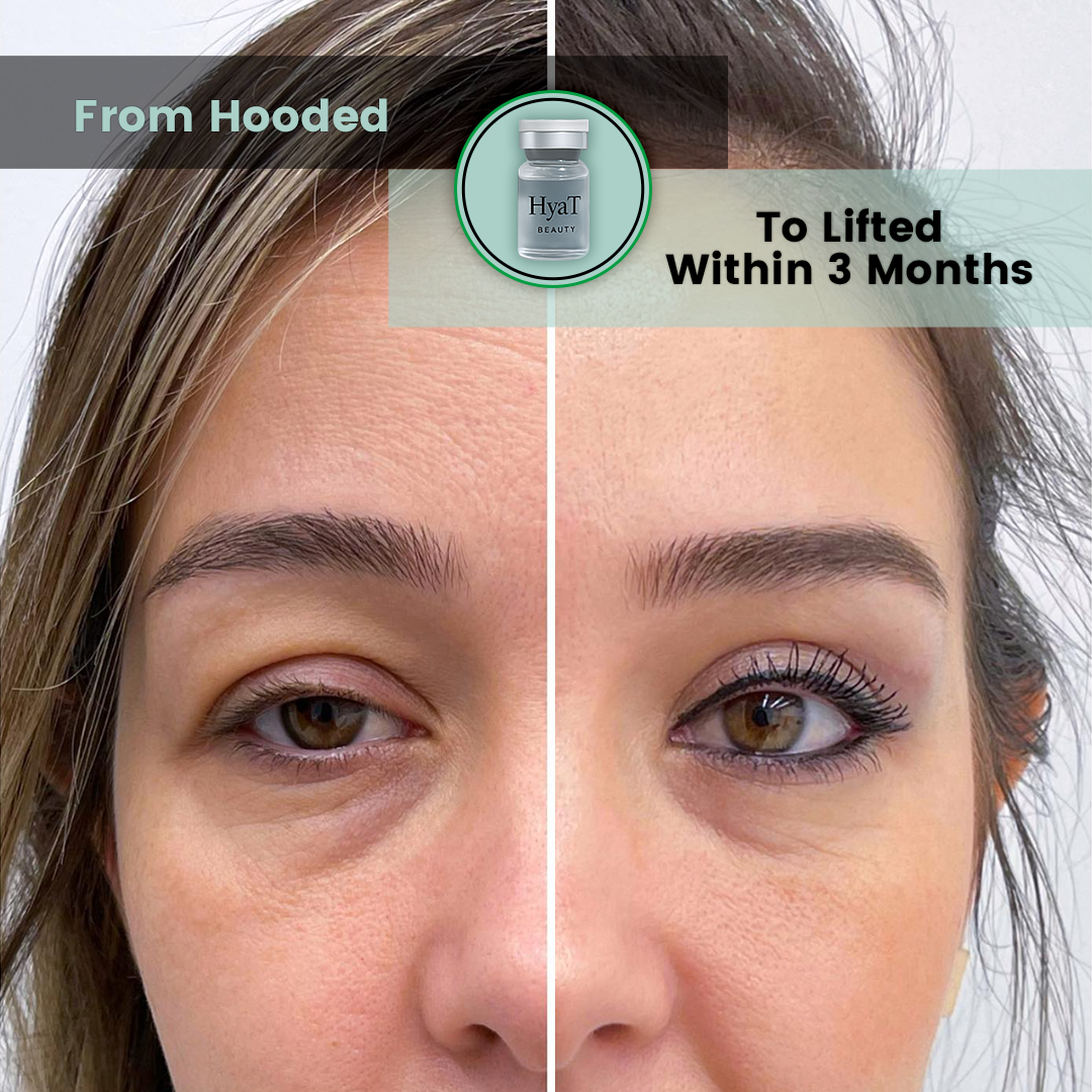 HyaT™ Upper Eyelid Matrixyl® 3000 & Adenosine Micro-Infusion System