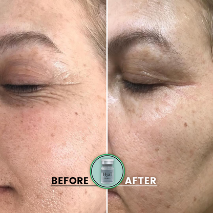 HyaT™ Lower Eyelid Matrixyl® 3000 & Adenosine Micro-Infusion System