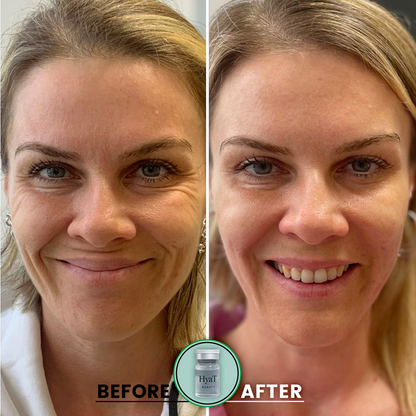 HyaT™ Lower Eyelid Matrixyl® 3000 & Adenosine Micro-Infusion System