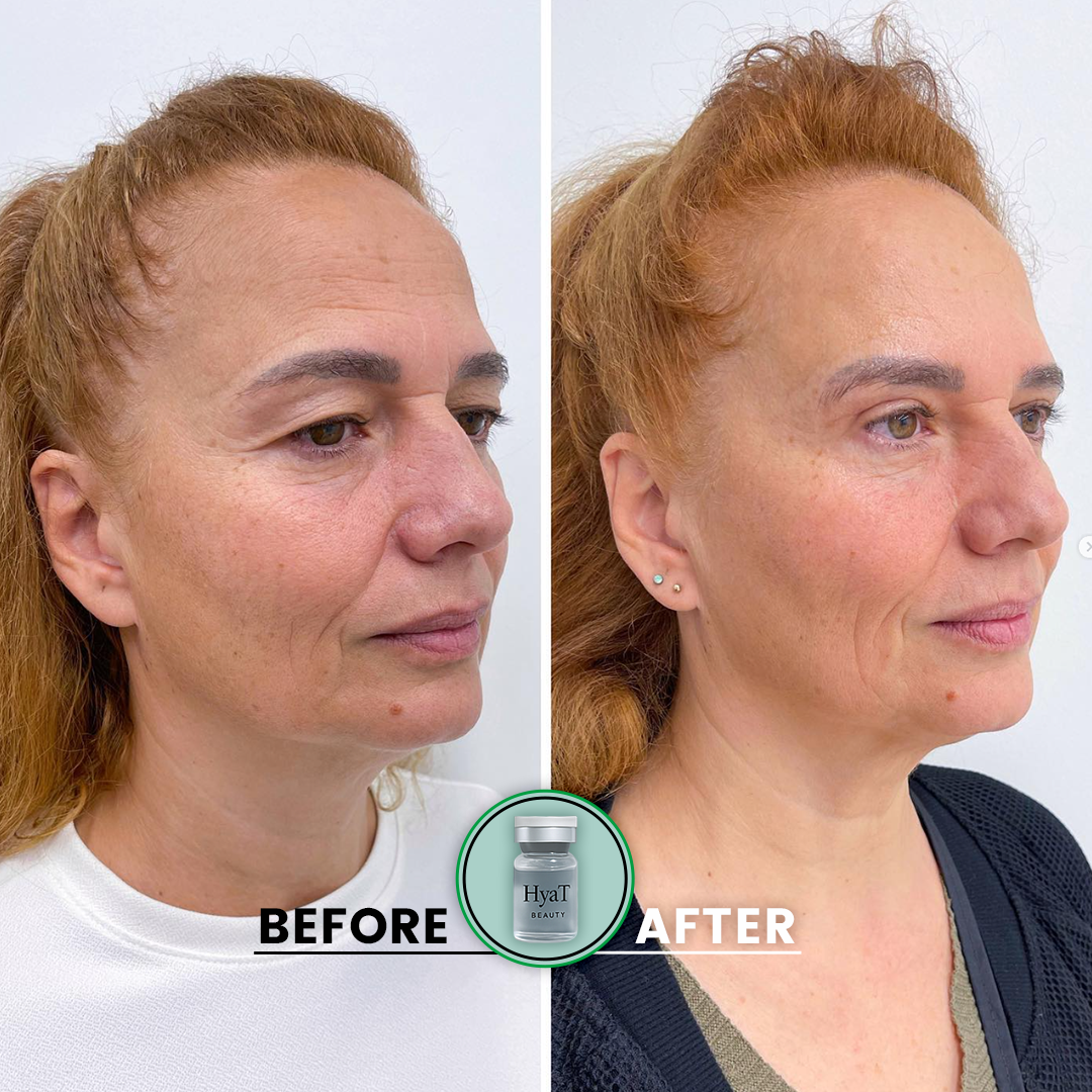 HyaT™ Upper Eyelid Matrixyl® 3000 & Adenosine Micro-Infusion System