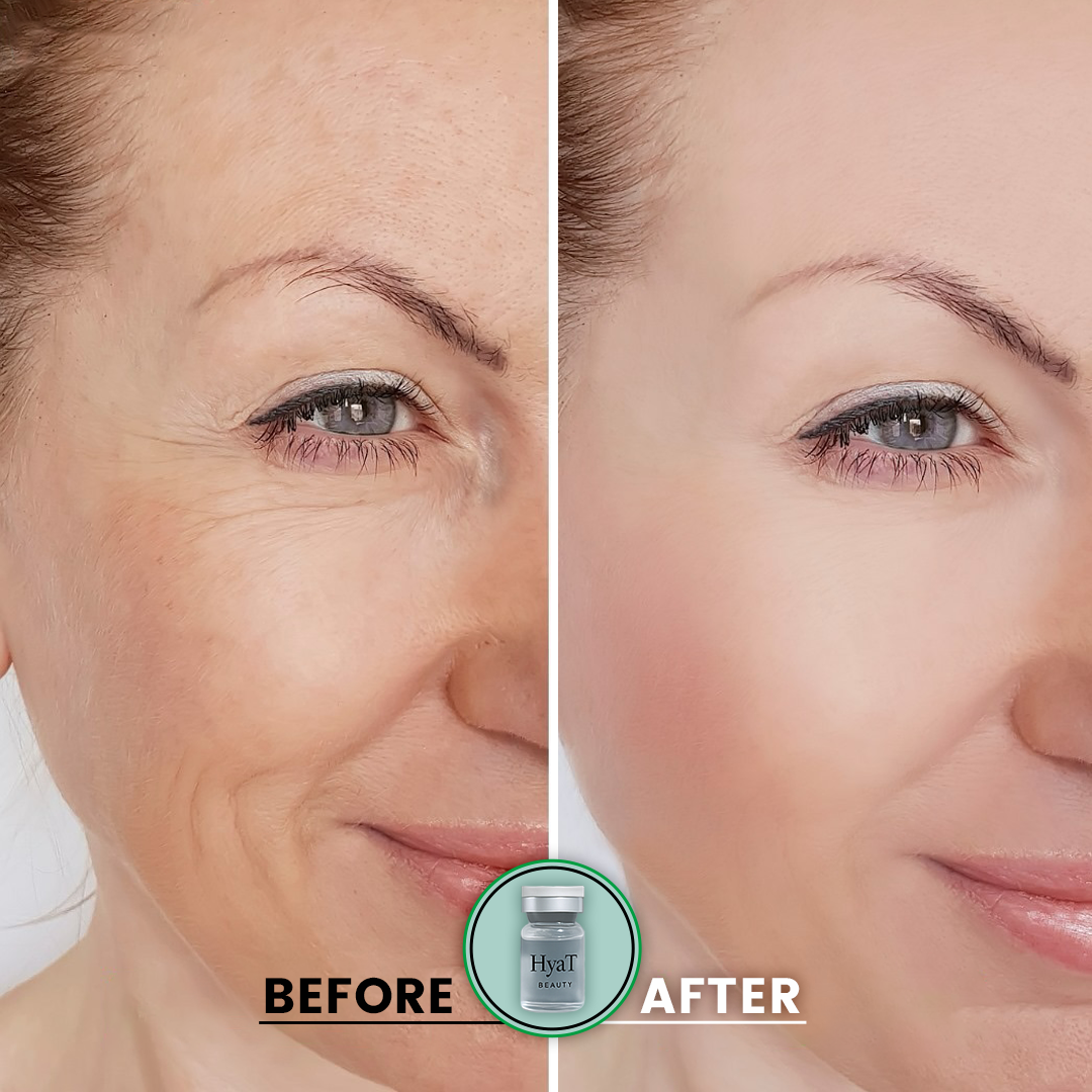 HyaT™ Lower Eyelid Matrixyl® 3000 & Adenosine Micro-Infusion System