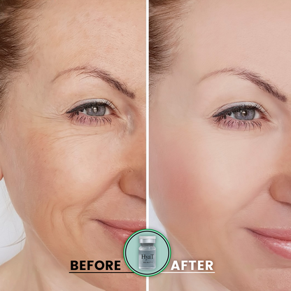 HyaT™ Lower Eyelid Matrixyl® 3000 & Adenosine Micro-Infusion System