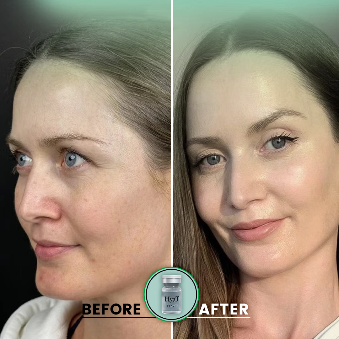 HyaT™ Upper Eyelid Matrixyl® 3000 & Adenosine Micro-Infusion System