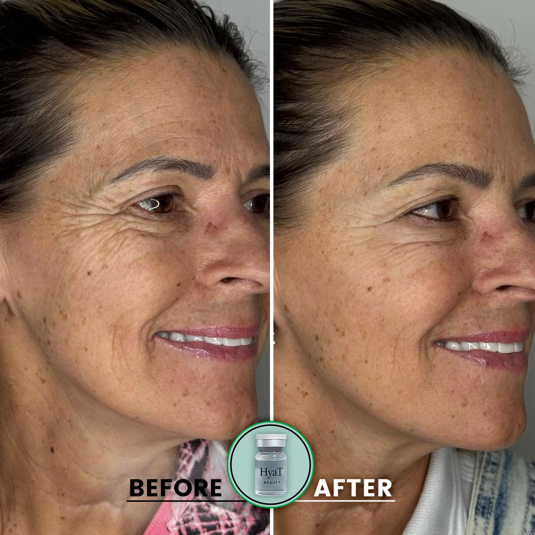 HyaT™ Lower Eyelid Matrixyl® 3000 & Adenosine Micro-Infusion System