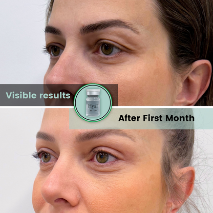 HyaT™ Upper Eyelid Matrixyl® 3000 & Adenosine Micro-Infusion System