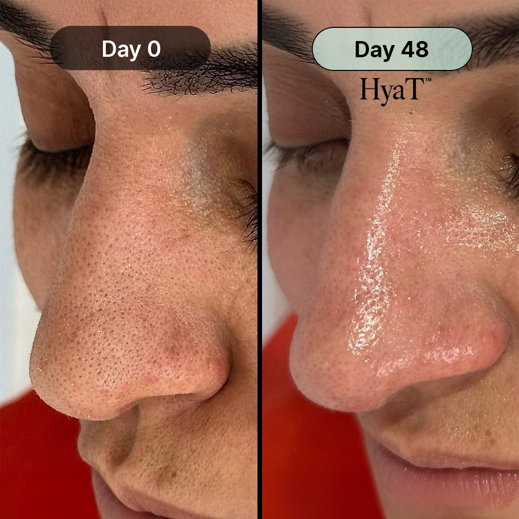 HyaT™ Pore Micro-Infusion System