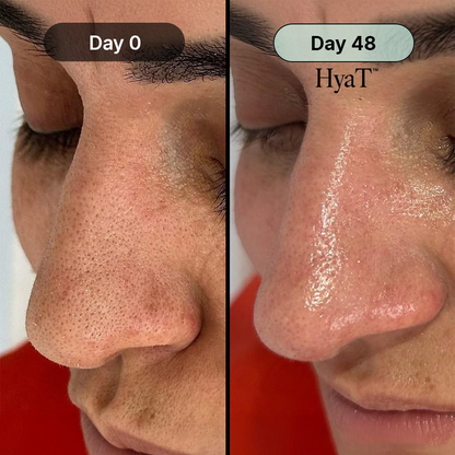 HyaT™ Pore Micro-Infusion System